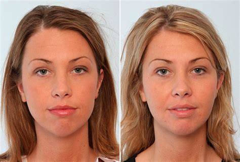 buccal fat removal leeds|Buccal Fat Pad Removal .